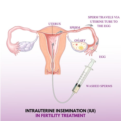 Intrauterine Insemination (IUI) in Delhi