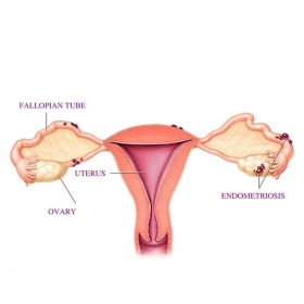Endometriosis in Raja Garden