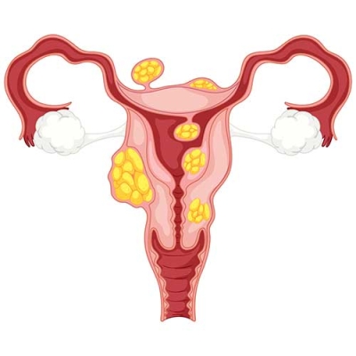 Fibroid Treatment in Lawrence Rd