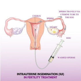Intrauterine Insemination (IUI) in Amar Colony